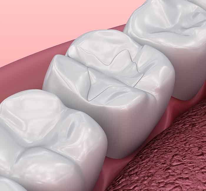 A 3D illustration of tooth-colored fillings