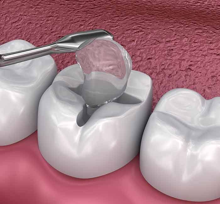 A 3D illustration of tooth-colored fillings being placed