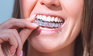 Woman inserting an Invisalign aligner