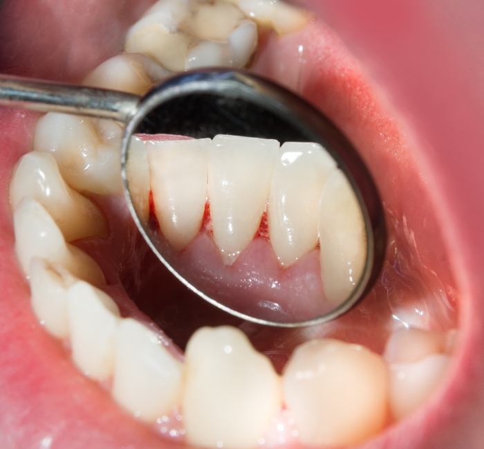 Closeup of smile during oral cancer screening