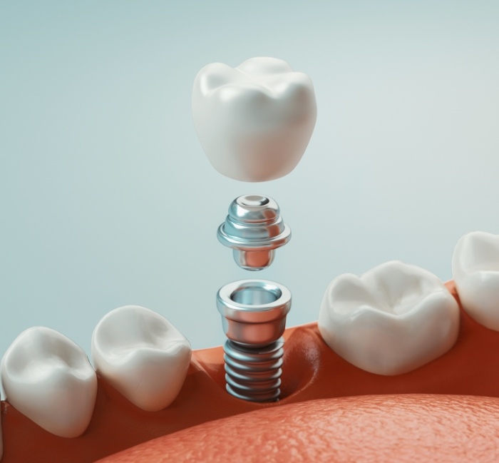 Animated smile during dental implant supported dental crown